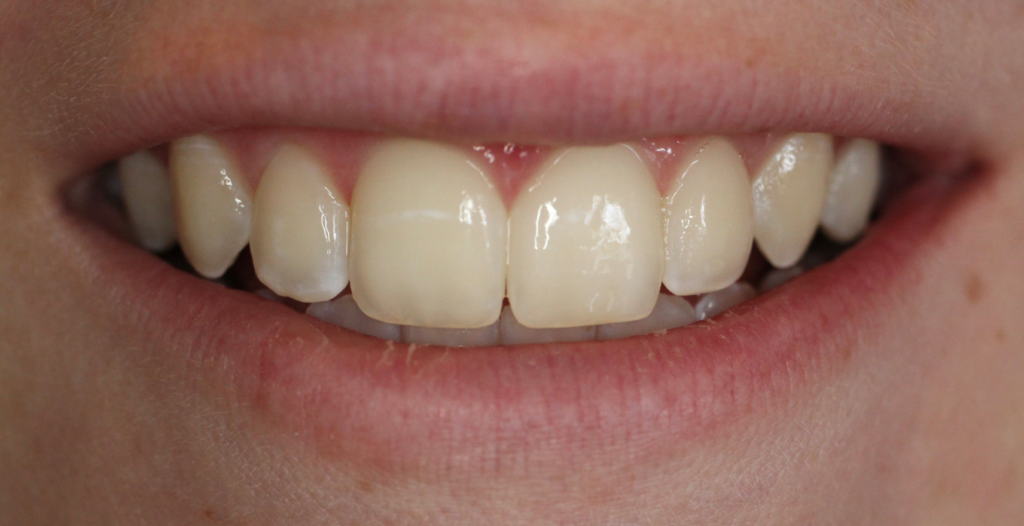 Invisalign After
