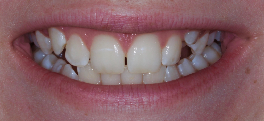 Invisalign Before