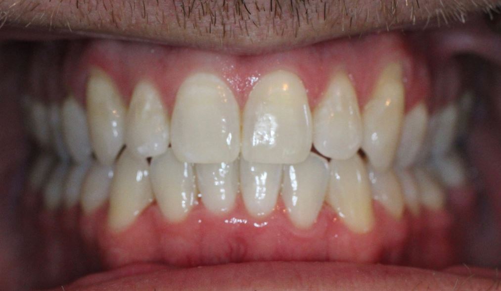 Teeth After Invisalign
