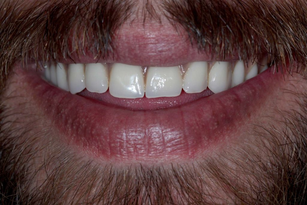 Dentures-After-Photo--1024x683