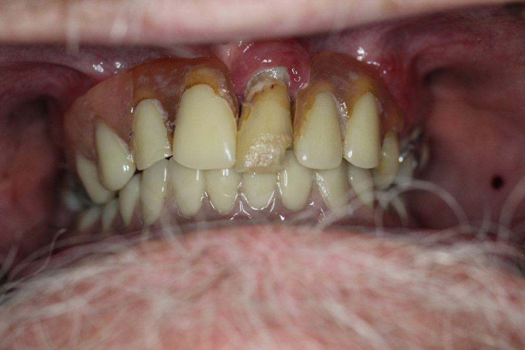 Full Mouth Restoration-Before-1024x682