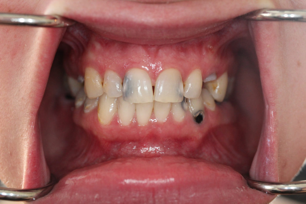 Mouth Restoration-Before-1024x682