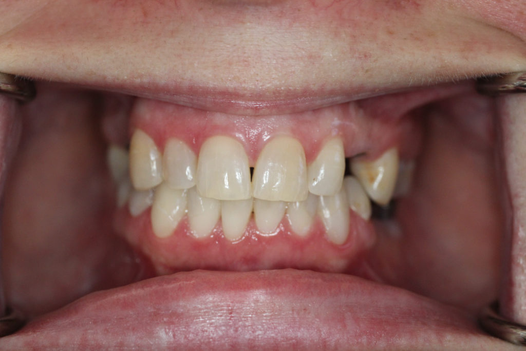 After-upper-and-lower-teeth-restored1-1024x683