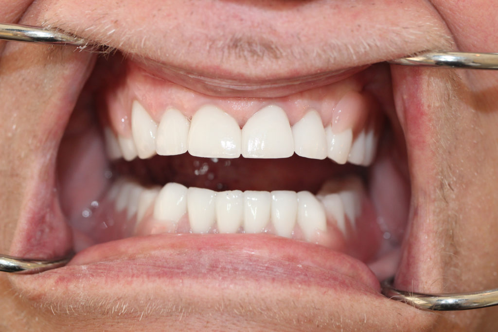 Full Mouth Restoration-After-1024x682