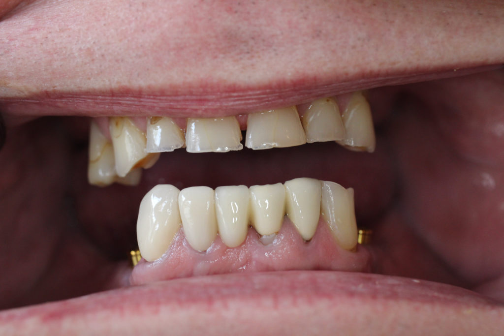 Full Mouth Restoration-Before-1024x682