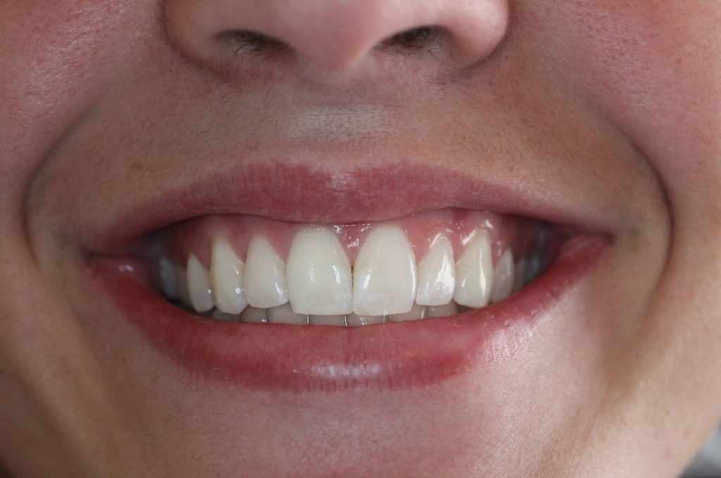 Composite and Whitening After