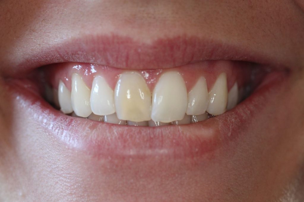 Composite and Whitening Before