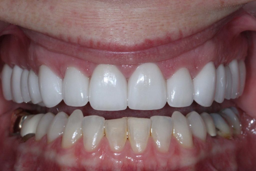 fmc-After-Photos-full-mouth-reconstruction-2-1024x683