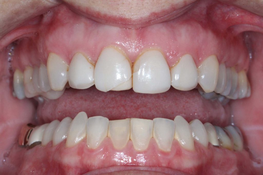 fmc-before-Photos-full-mouth-reconstruction-1-1024x683