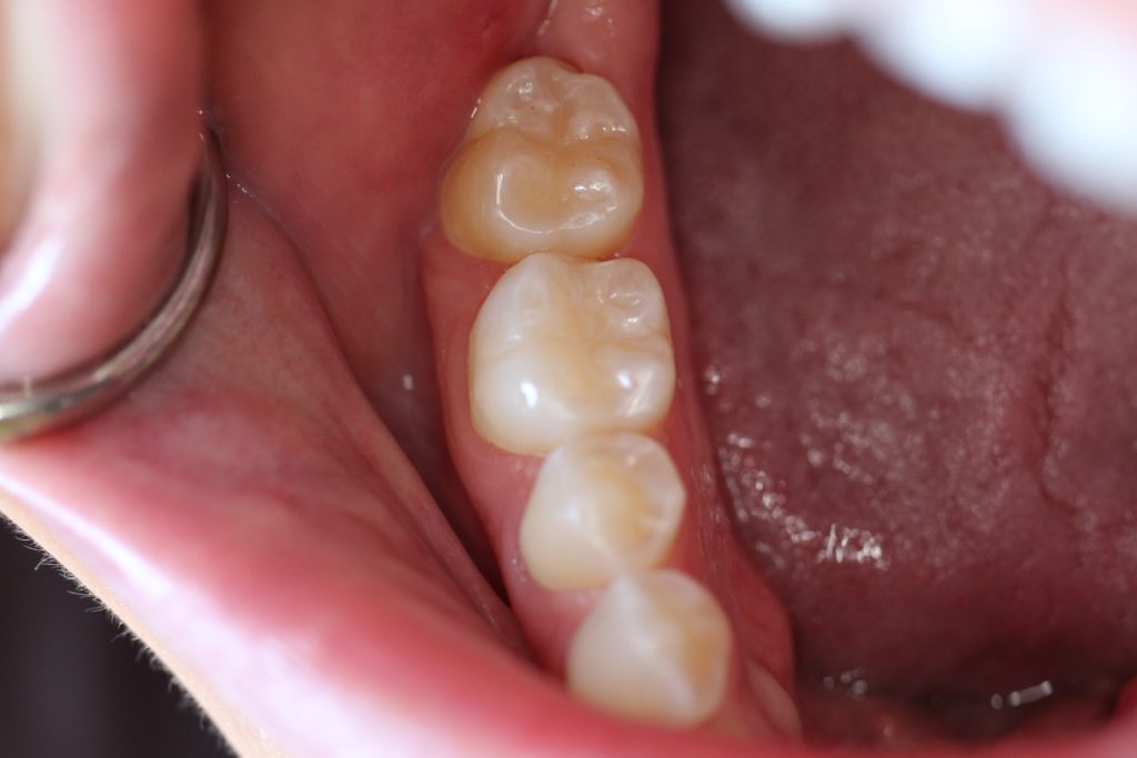 lower-white-fillings-after-1024x683