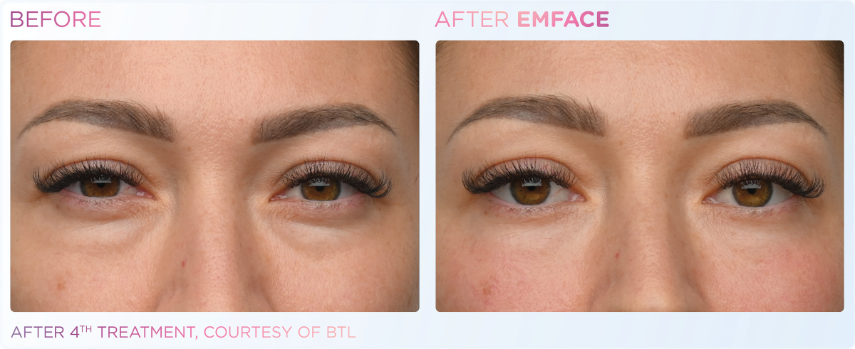 EMface eyes before and after
