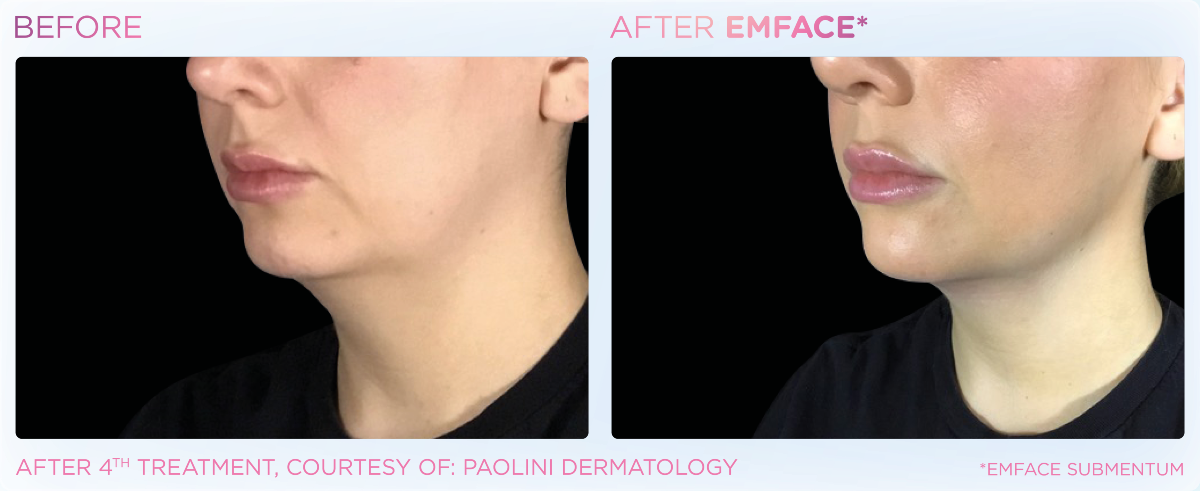 EMface jaw line before and after