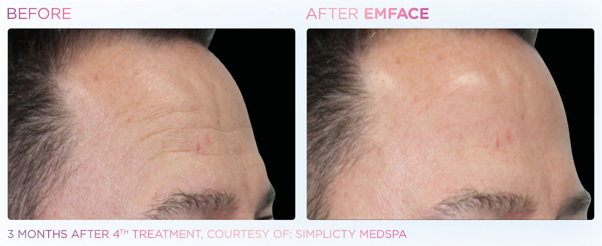 EMface forehead before and after