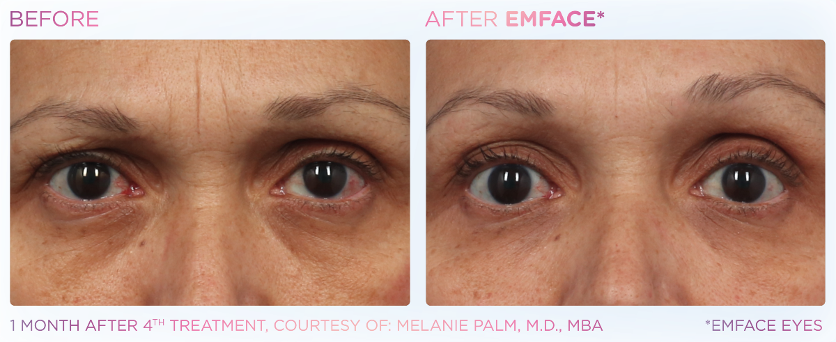 Emface Eyes Before and After