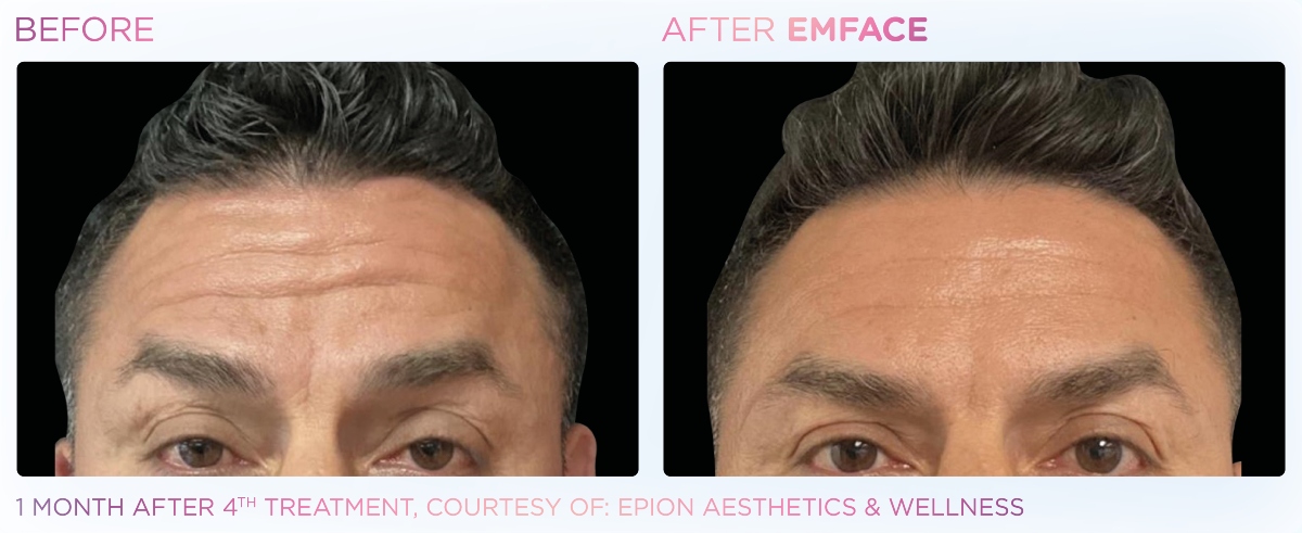 Emface forehead before and after