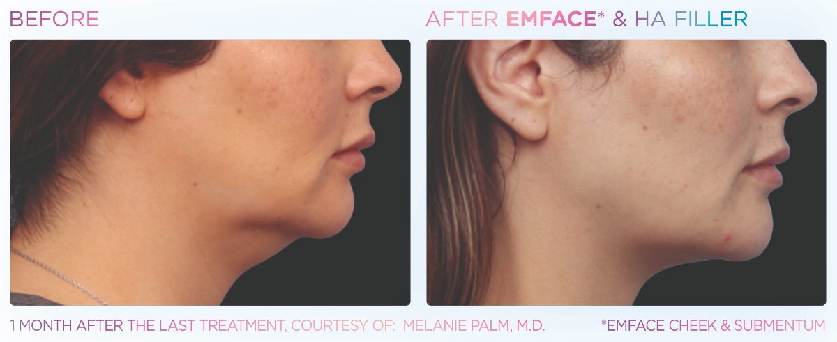 Emface with filler for chin and neck