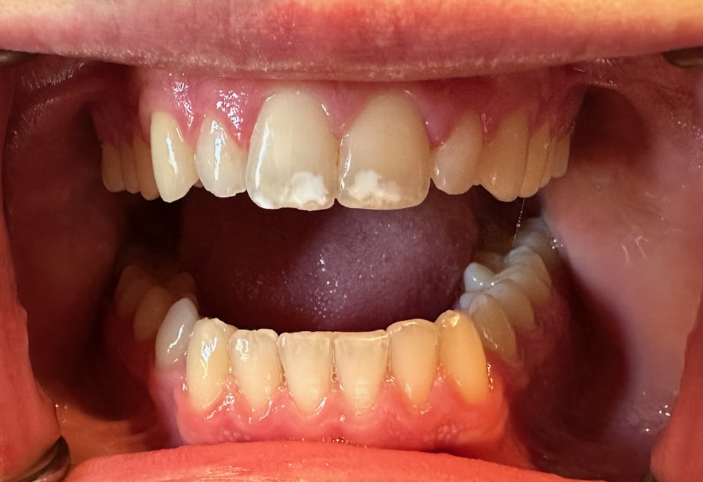 Composite Before