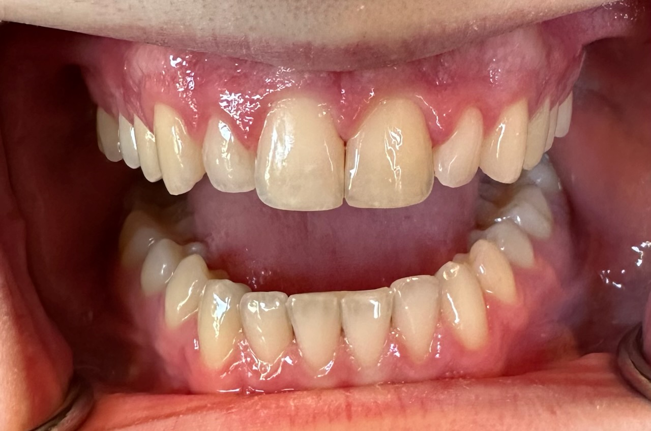 Composite After